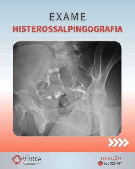 🩺✨ HISTEROSSALPINGOGRAFIA: o que precisa saber